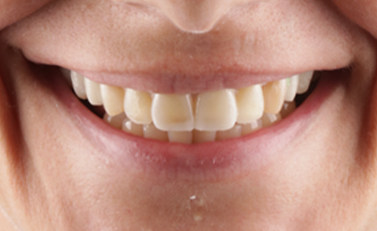 Crown Point Smiles | Oral Exams, Extractions and Digital Impressions