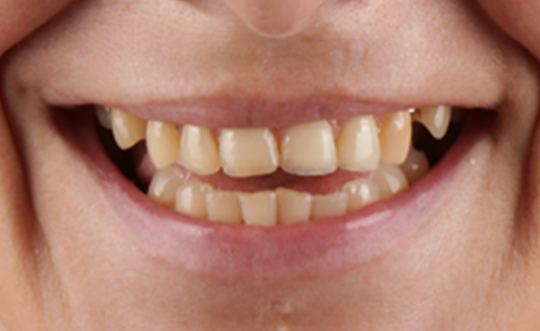 Crown Point Smiles | Dental Fillings, Laser Dentistry and Teeth Whitening