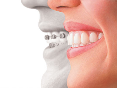 Crown Point Smiles | Veneers, Dental Cleanings and Digital Scanners