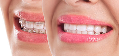 Crown Point Smiles | Veneers, All-on-4 reg  and Pediatric Dentistry