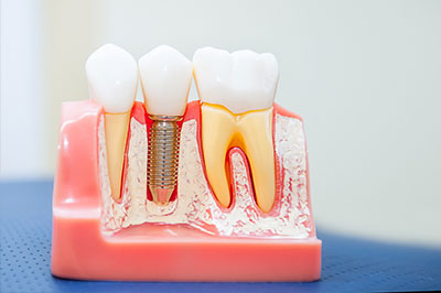 Crown Point Smiles | CBCT, Cosmetic Dentistry and Implant Restorations