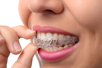 Invisalign 46307