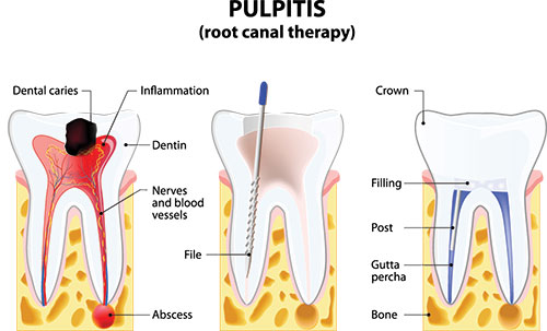 Crown Point Smiles | E4D, Teeth Whitening and Veneers