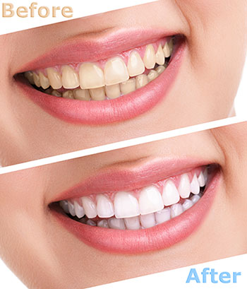 Crown Point Smiles | Laser Dentistry, Oral Cancer Screening and Veneers