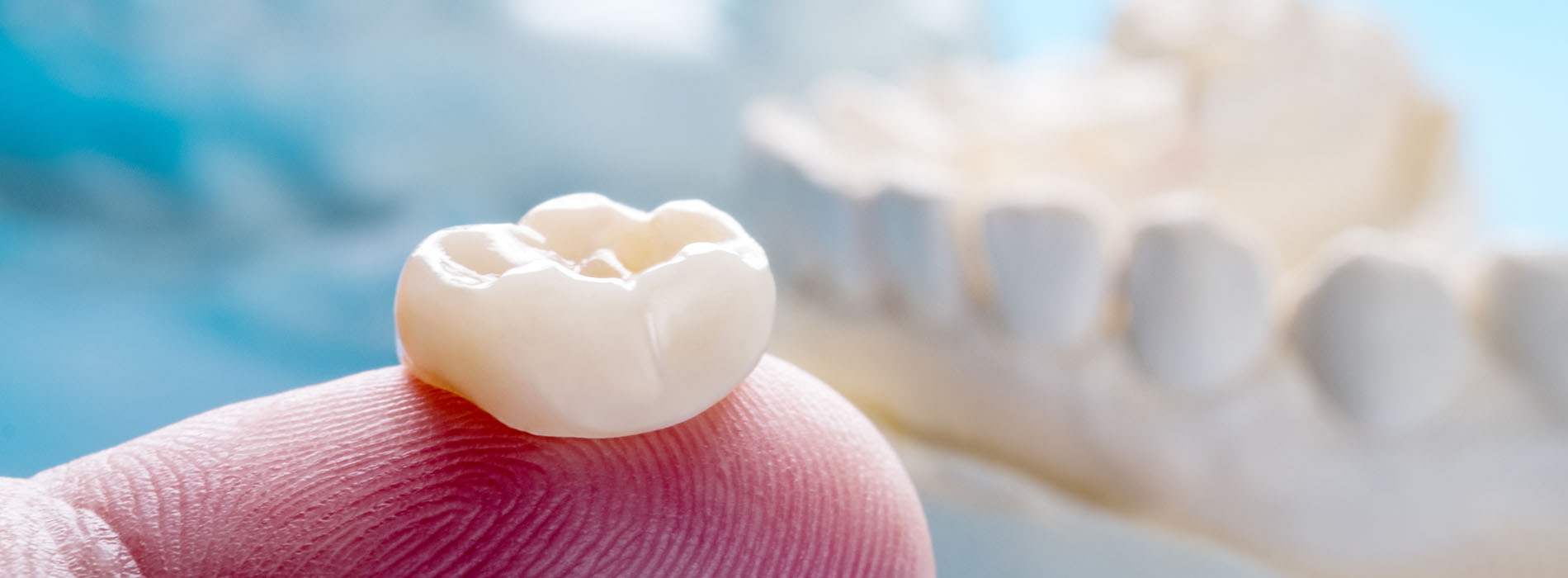 Crown Point Smiles | All-on-6, Implant Dentistry and Night Guards