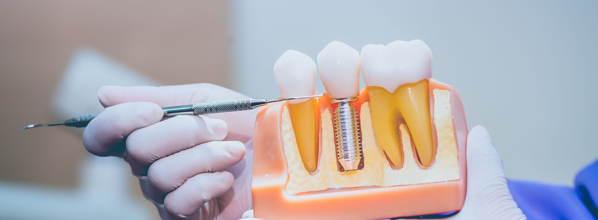 Crown Point Smiles | Ceramic Crowns, Digital Impressions and Implant Restorations