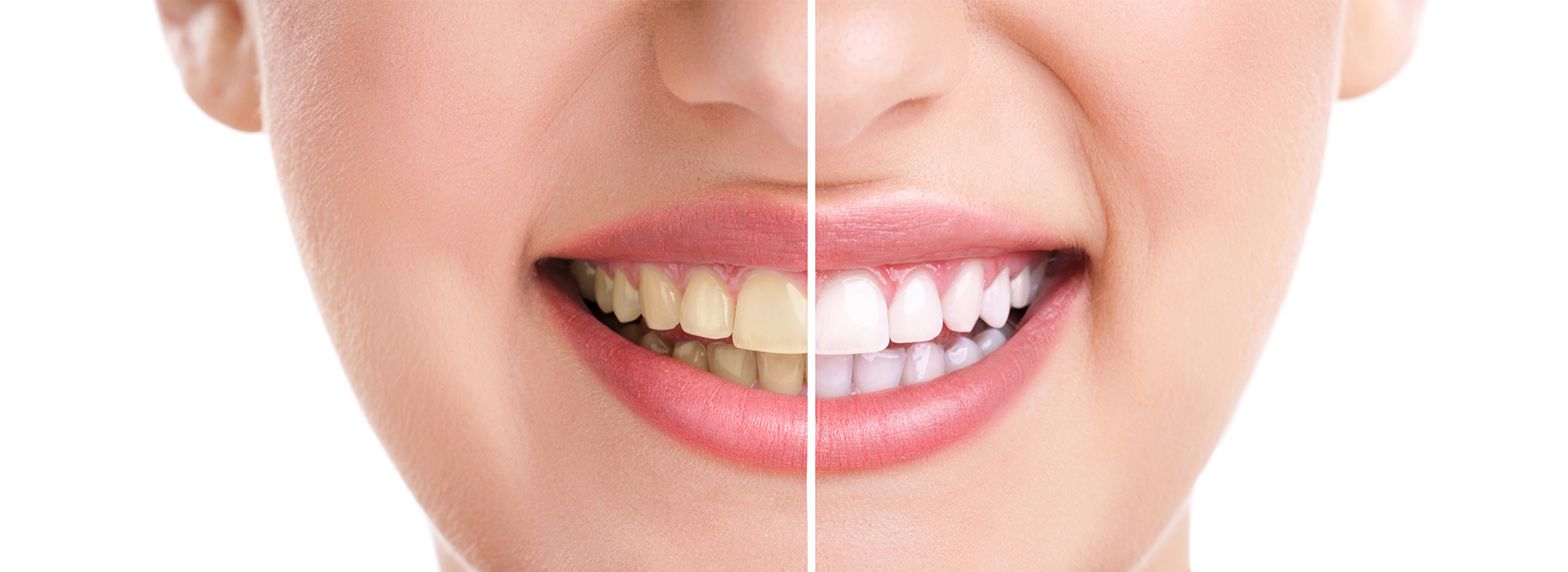 Crown Point Smiles | Emergency Treatment, Dental Fillings and Teeth Whitening