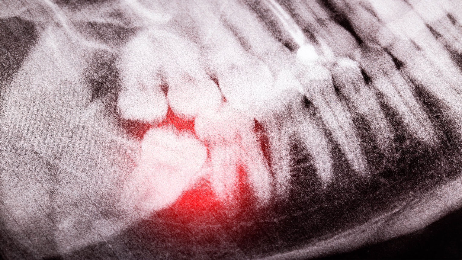 What Do Dental X-Rays Show?