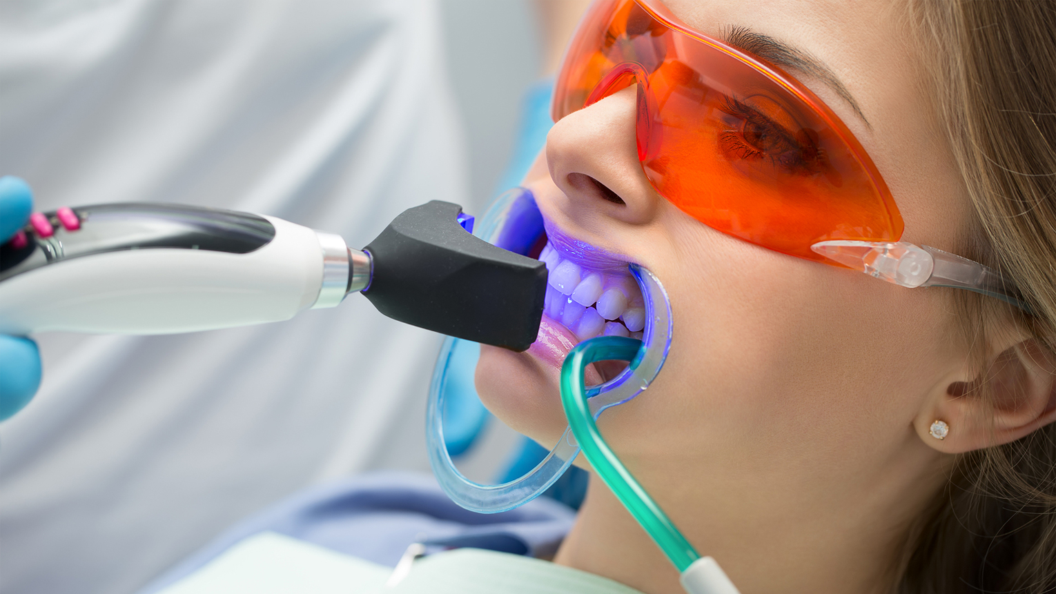 What to Know Before Professional Teeth Whitening